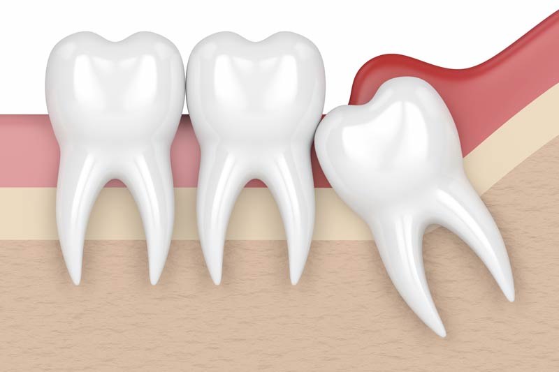 Wisdom Tooth Removal in Los Altos